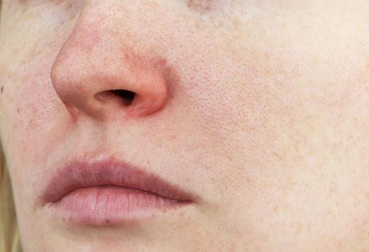 rosacea advice