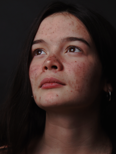 acne treatment
